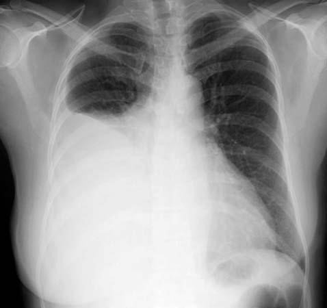 Xray